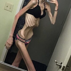 MIX-Extreme-cases-of-anorexia-24.jpg