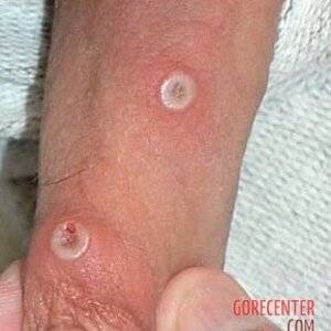 MIX_-People-infected-with-mpox-5.jpg