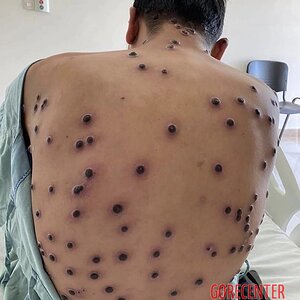 MIX_-People-infected-with-mpox-2.jpg