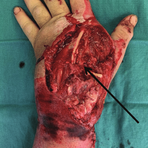 Dorsal-degloving-injury-of-the-hand-and-wrist-after-rollover-atV-accident-with-exposed.png