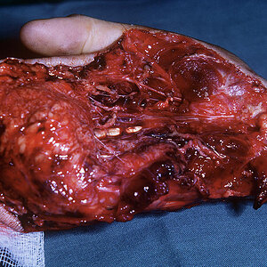 degloving-injury-mike-devlinscience-photo-library.jpg