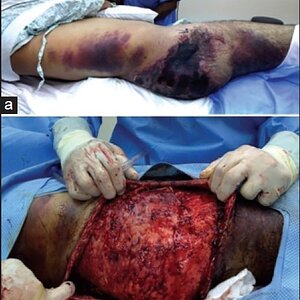 Major-degloving-injury-in-a-patient-with-severe-pelvic-injury-that-was-diagnosed-late-a.jpg