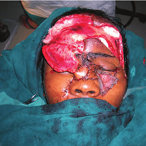 Intra-operative-picture-showing-canthopexy-harvested-nasolabial-flap-and-forehead-flap.png