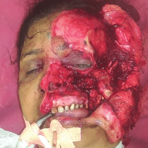 Preoperative-picture-showing-complete-hemifacial-and-zygomatic-avulsion-Fig-2.png