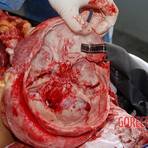 Autopsy-of-brain-after-stroke-3.jpg