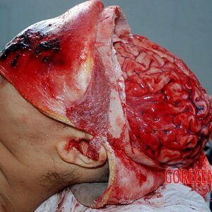 Autopsy-of-brain-after-stroke-4.jpg