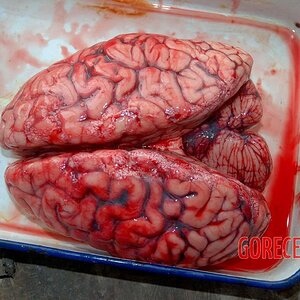 Autopsy-of-brain-after-stroke-2.jpg