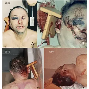 Other-autopsy-images-showing-the-extraordinary-swelling-on-the-right-side-of-the-victims.webp