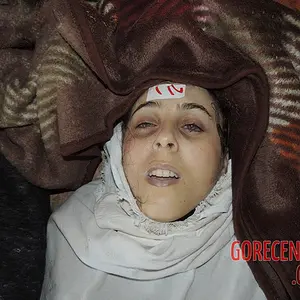 female-victims-of-chemical-attack-2-390996322.webp