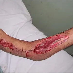 Fasciotomy-of-the-forearm-and-partial-wound-closure-following-brachial-artery-repair-The.webp