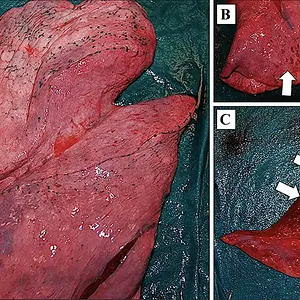 Blast effects on the lung.webp