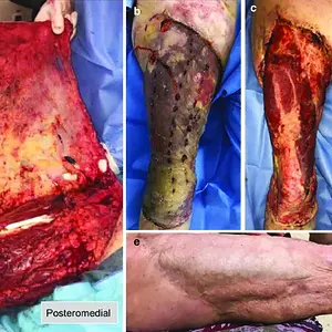 a-Severe-open-degloving-injury-in-the-right-thigh-of-a-55-year-old-patient-She-was.webp