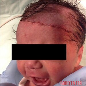 Partially-scalped-newborn-during-cesarean-delivery-1.jpeg