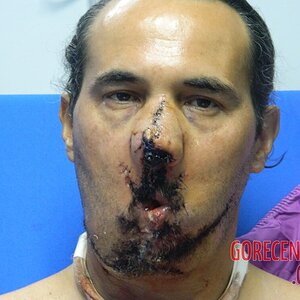 Dude-with-part-of-his-face-blown-off-undergoes-surgery-58.jpg