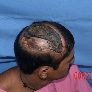 Auto-transplantation-of-skin-on-head-2.jpeg