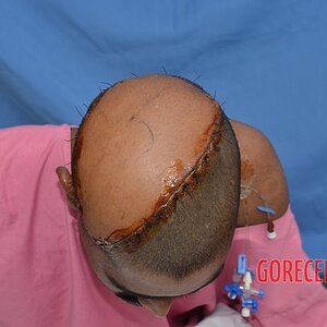 Auto-transplantation-of-skin-on-head-12.jpeg