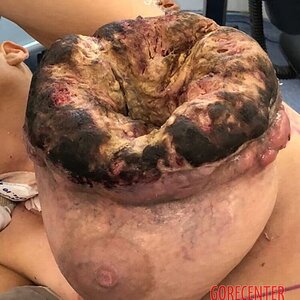 Breast-cancer-surgery-in-extreme-stage-2.jpeg