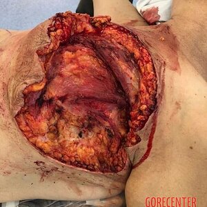 Breast-cancer-surgery-in-extreme-stage-3.jpeg