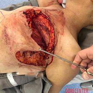 Breast-cancer-surgery-in-extreme-stage-4.jpeg