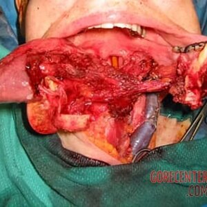 Consequences-of-oral-cancer-3.jpg