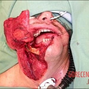 Consequences-of-oral-cancer-8.jpg