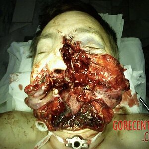 Facial-reconstruction-after-accident-1.jpg