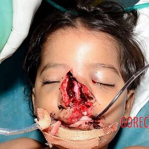 Doctors-removed-a-fence-from-face-of-7-year-old-boy-1.jpeg