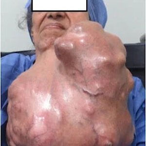 Removing-cancer-from-womans-neck-5.jpg