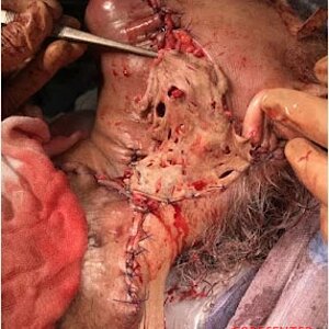 Removing-cancer-from-womans-neck-3.jpg