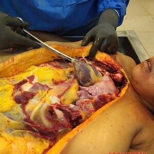 Autopsy-of-curvy-woman-9.jpg