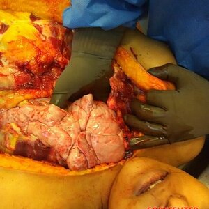 Autopsy-of-curvy-woman-10.jpg