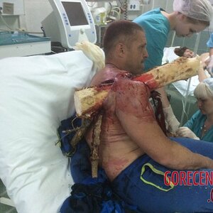 Pilots-shoulder-is-impaled-by-tree-branch-2.jpg