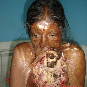 Disfigured-woman-due-to-skin-disease.jpeg