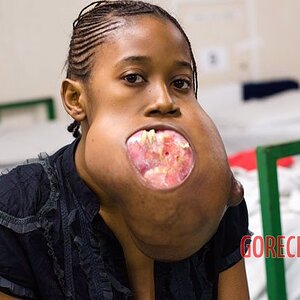 Teen-girl-with-huge-facial-tumor-2.jpg