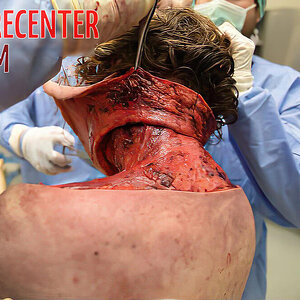 Skinned-woman-on-autopsy-table-2.jpg