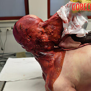 Skinned-woman-on-autopsy-table-3.jpg