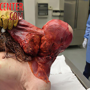 Skinned-woman-on-autopsy-table-4.jpg