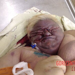 Morbidly-obese-woman-in-morgue-10.jpg