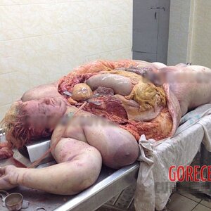 Morbidly-obese-woman-in-morgue-2.jpg