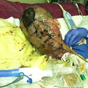 Patient-with-severe-burns-all-over-his-body-1.jpg