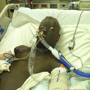 Patient-with-severe-burns-all-over-his-body-3.jpg