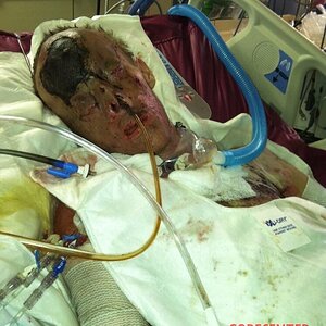 Patient-with-severe-burns-all-over-his-body-5.jpg