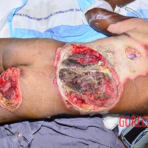 Extreme-electrical-burns-5.jpg