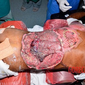 Extreme-electrical-burns-16.jpg