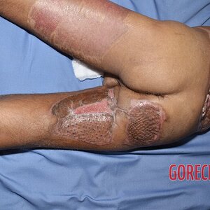 Extreme-electrical-burns-24.jpg