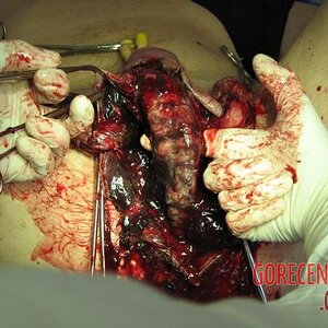 Necrosis-of-testicles-5.jpg