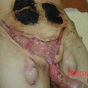 Necrosis-of-testicles-18.jpg