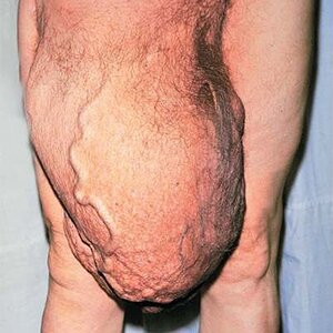 Large-right-inguinal-hernia-1.jpg