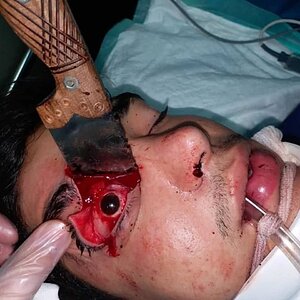 Knife in eye (1).jpg