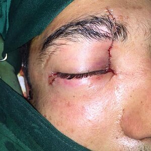 Knife in eye (6).jpg